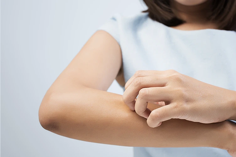 How to prevent jewelry rash